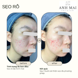 H&igrave;nh ảnh thực tế Before – After Sẹo