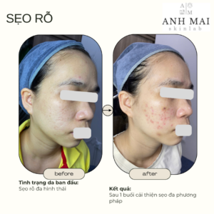 H&igrave;nh ảnh thực tế Before – After Sẹo