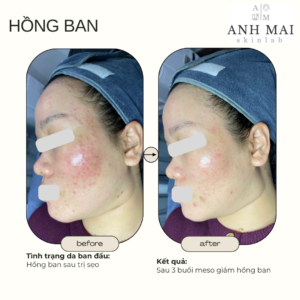 H&igrave;nh ảnh thực tế Before – After Th&acirc;m S&aacute;ng Da
