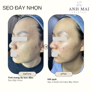 H&igrave;nh ảnh thực tế Before – After Sẹo
