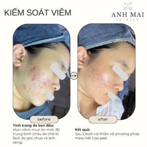 H&igrave;nh ảnh thực tế Before – After Mụn