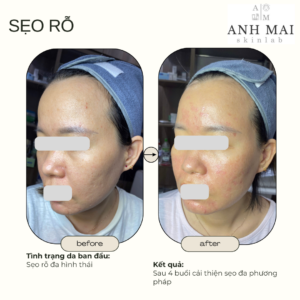 H&igrave;nh ảnh thực tế Before – After Sẹo