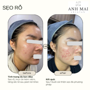 H&igrave;nh ảnh thực tế Before – After Sẹo