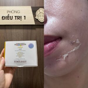 H&igrave;nh Ảnh Thực Tế Peel Da