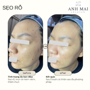 H&igrave;nh ảnh thực tế Before – After Sẹo