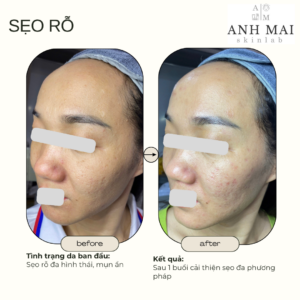 H&igrave;nh ảnh thực tế Before – After Sẹo