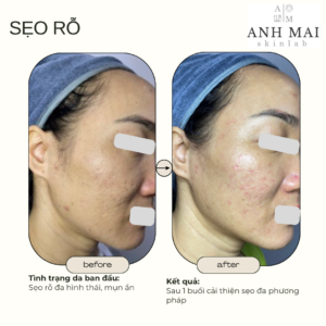 H&igrave;nh ảnh thực tế Before – After Sẹo