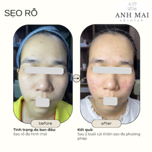 H&igrave;nh ảnh thực tế Before – After Sẹo