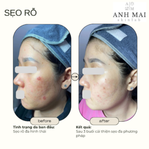 H&igrave;nh ảnh thực tế Before – After Sẹo