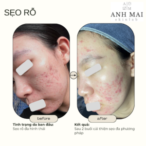 H&igrave;nh ảnh thực tế Before – After Sẹo